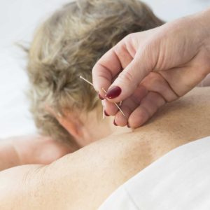 Acupuncture